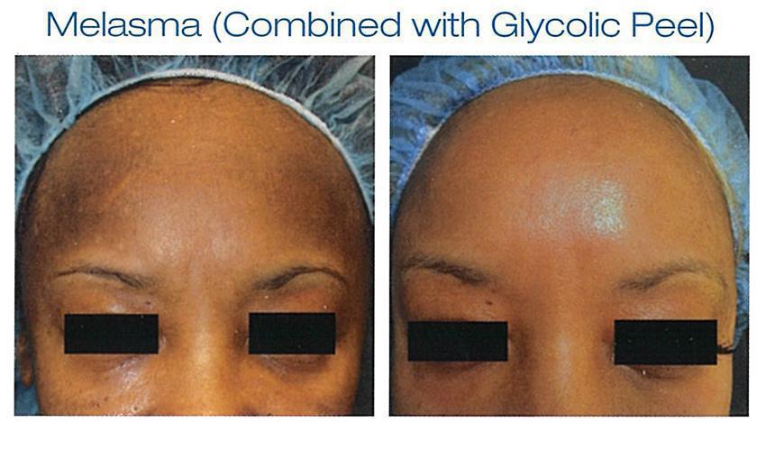 Melasma And Hyperpigmentation In Brooklyn Ny Dr Ghatan Dermatology