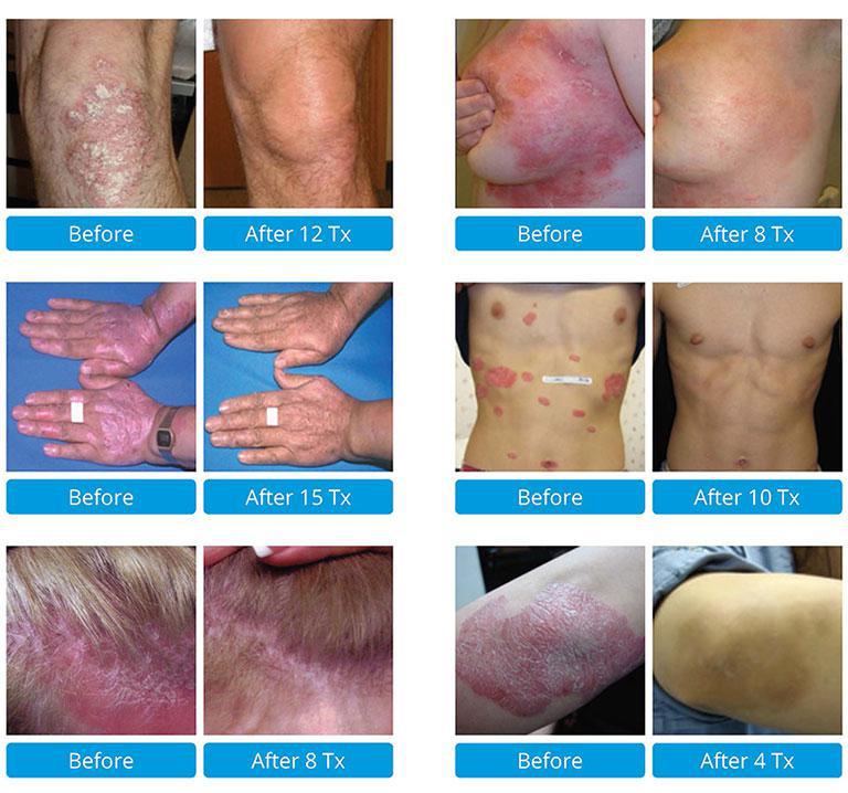 Psoriasis In Brooklyn Ny Dr Ghatan Dermatology Cosmetic And Laser